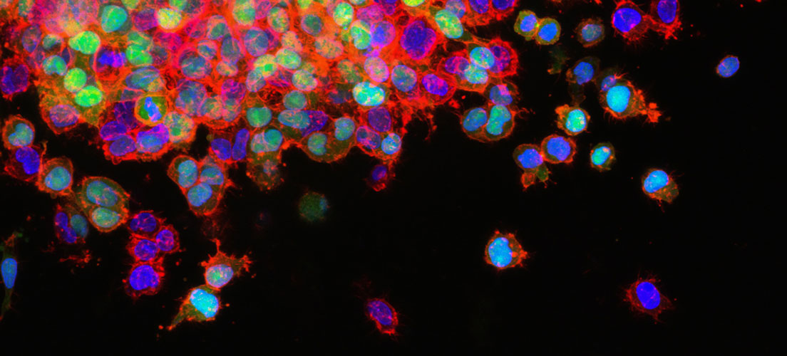 Lung-Cancer-Metastasis-Cells Lung-Cancer-Metastasis-Cells